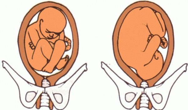На каком сроке ребенок должен перевернуться вниз головой и виды предлежания
