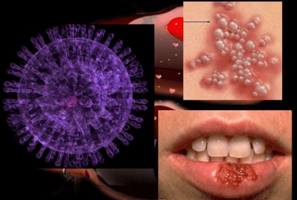 Последствия от герпеса на губе при беременности, лечение и профилактика