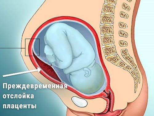 Причины и симптомы отслойки плаценты на разных сроках, лечение и последствия