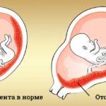 Причины и симптомы отслойки плаценты на разных сроках, лечение и последствия