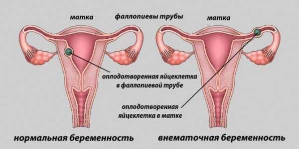 Признаки и симптомы внематочной беременности на ранних сроках, как избежать