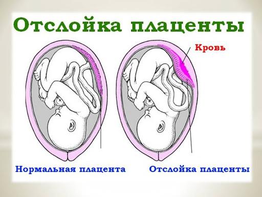 Причины коричневых выделений на разных сроках беременности и что делать