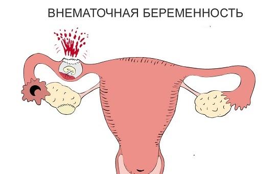 Причины коричневых выделений на разных сроках беременности и что делать