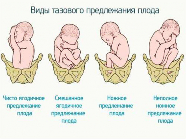 Виды тазовых предлежаний и биомеханизм родов, упражения для переворота плода