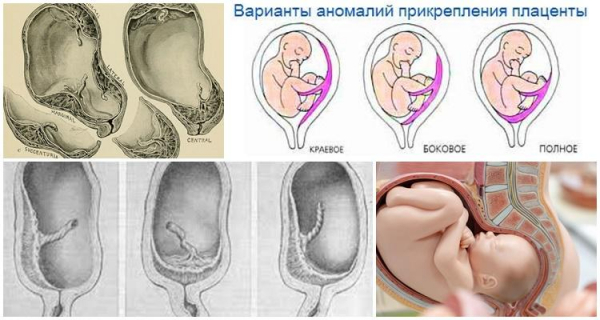 Виды и симптомы предлежания плаценты, чем опасно и меры профилактики